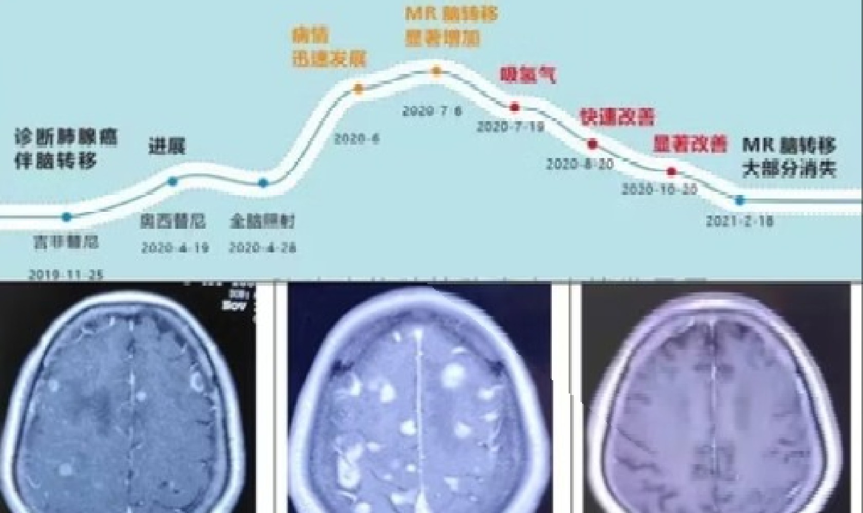 2%氫氣持續吸入的抗衰老效應研究報告
