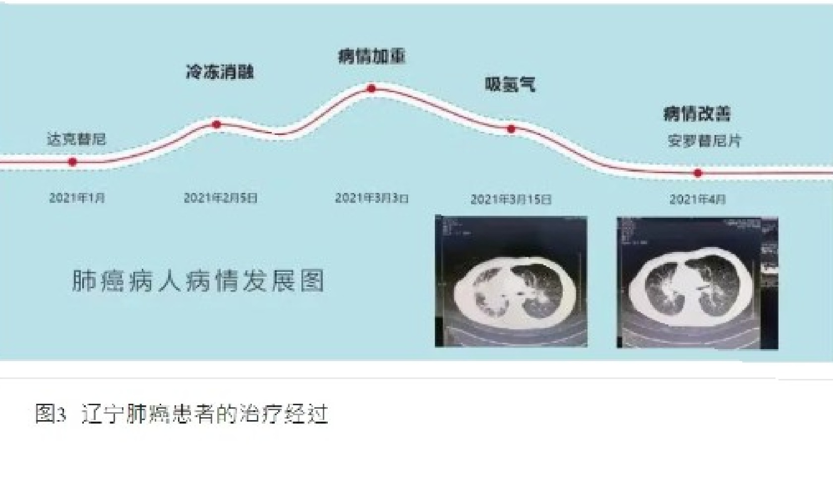 66歲患癌又救近萬癌癥患者，被央視譽為“癌癥克星”｜氫氧吸入對肺癌看來有“特”效